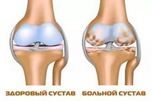 Лечение артроза