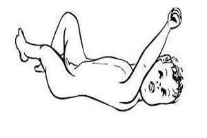 Лечение атонически–астатической формы ДЦП