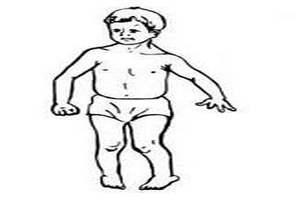 Лечение гемипаретической формы ДЦП