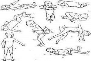 Гиперкинетическая форма дцп