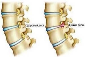 Грыжа межпозвонкового диска