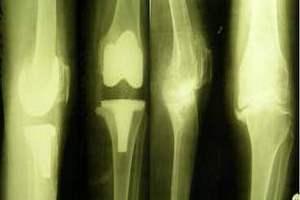 Контрактура сустава