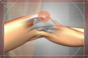 Виды контрактур