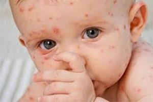 Корь у детей