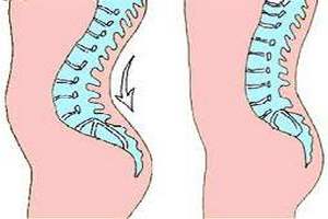 Лечение лордоза