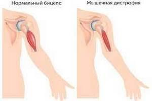 Мышечная дистрофия
