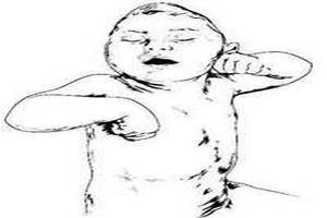 Олигофрения