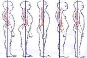 Нарушение осанки