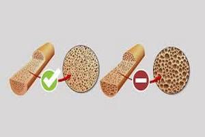 Остеопороз