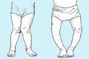 Рахит у грудничков