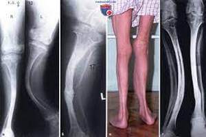 Синдром Лобштейна