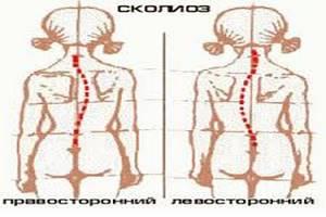 Сколиоз грудного отдела позвоночника