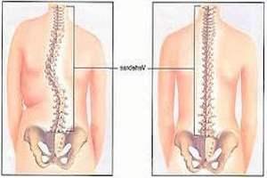 Лечение сколиоза