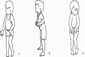 Лечение спастической диплегии