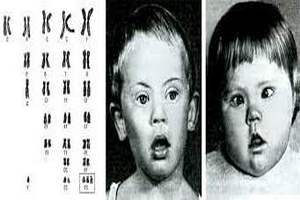 Значение иппотерапии для больных синдромом Дауна