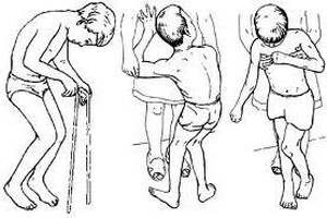 Виды тетрапареза