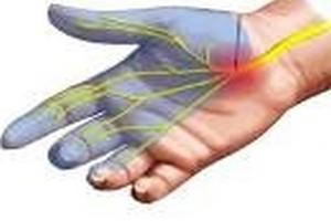 Туннельный синдром запястья