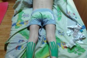 Кінезіотейпування